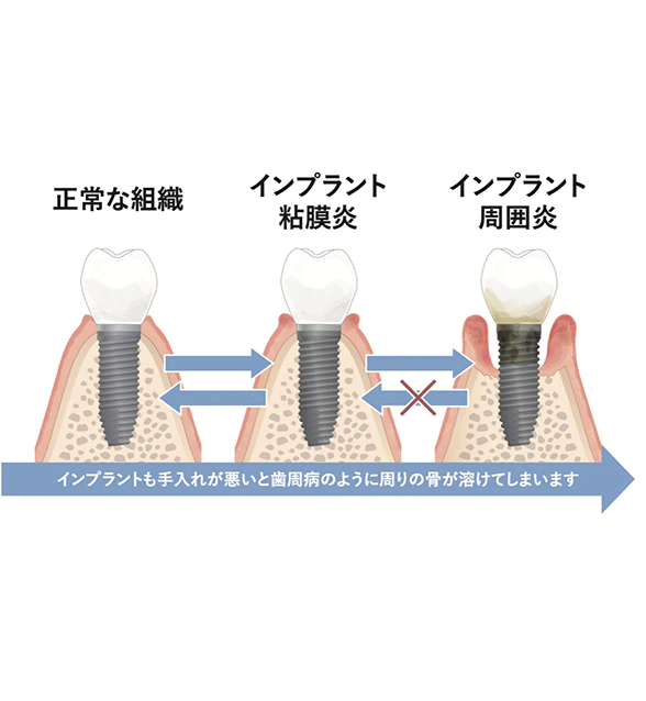 インプラント周囲炎と粘膜炎