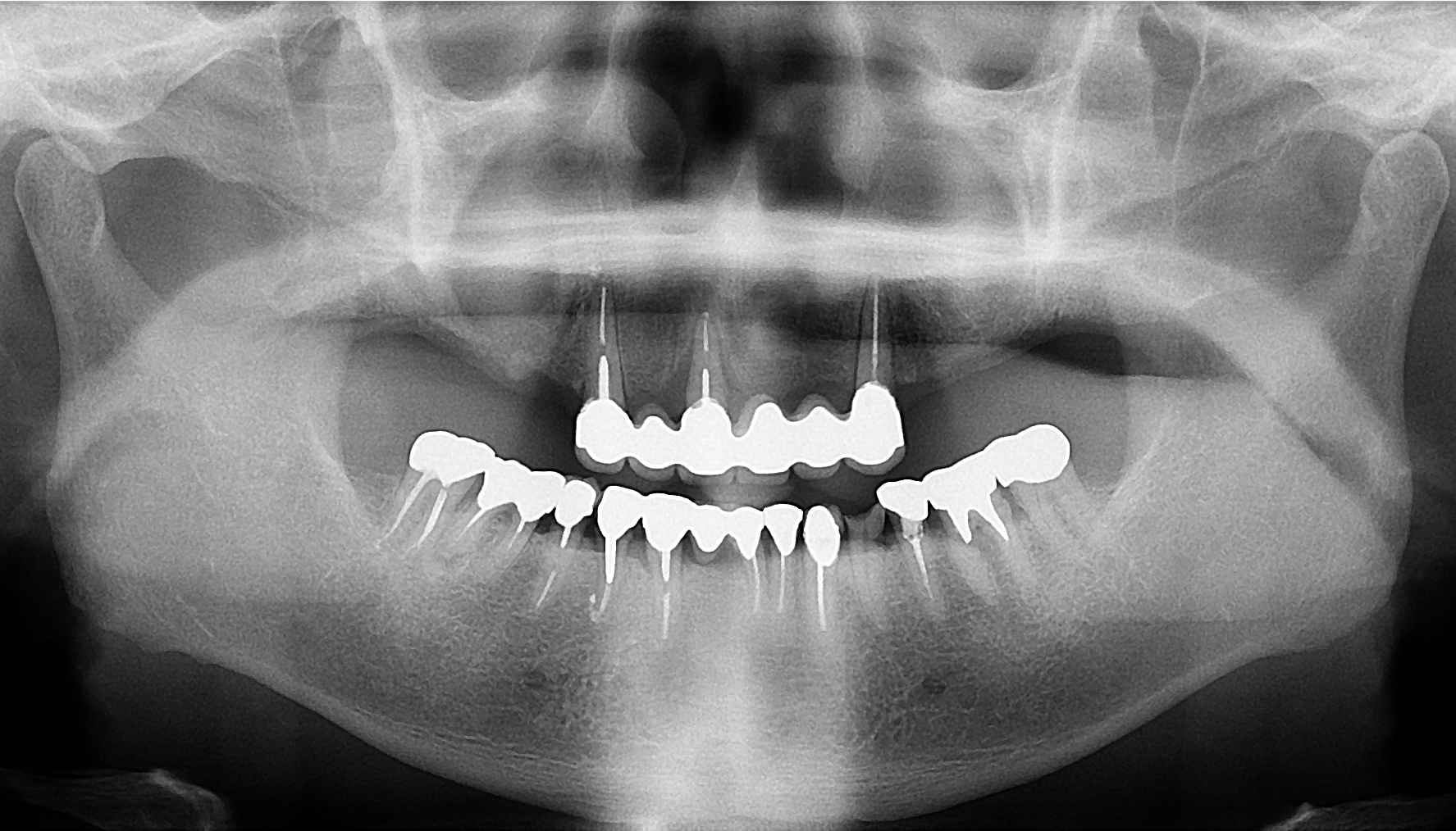 旭川でインプラント治療はエルム駅前歯科クリスタル｜治療からメンテナンスまでインプラントを末長くお使いいただくために世界品質のノーベルバイオケア、ストローマンのインプラントを提供しています。安価なインプラントでメンテナンスに苦しまないようにインプラントのことなら、旭川のエルム駅前歯科クリスタルにお気軽にご相談ください｜毎月インプラント無料相談会を実施して１０年、多くの皆様に正しいインプラントの理解を啓蒙しています