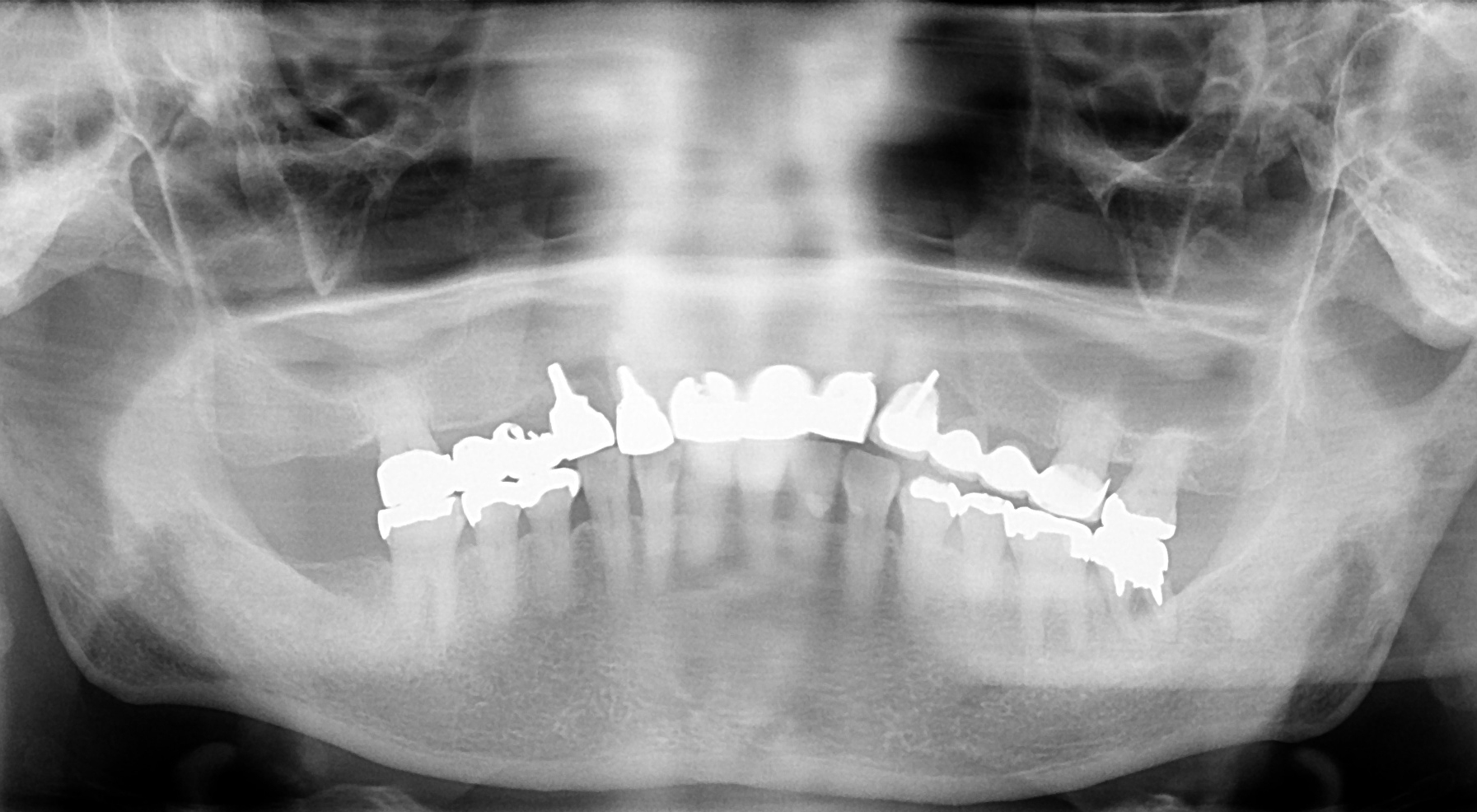 旭川でインプラント治療はエルム駅前歯科クリスタル｜治療からメンテナンスまでインプラントを末長くお使いいただくために世界品質のノーベルバイオケア、ストローマンのインプラントを提供しています。安価なインプラントでメンテナンスに苦しまないようにインプラントのことなら、旭川のエルム駅前歯科クリスタルにお気軽にご相談ください｜毎月インプラント無料相談会を実施して１０年、多くの皆様に正しいインプラントの理解を啓蒙しています